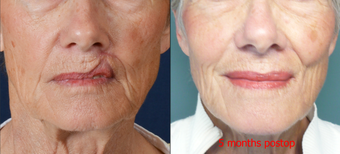 65-year-old with poor lip scarring repaired with local flap reconstruction before 672296