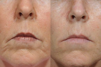 Dermal Fillers 850330