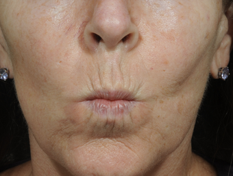 Dermal Fillers after 850330