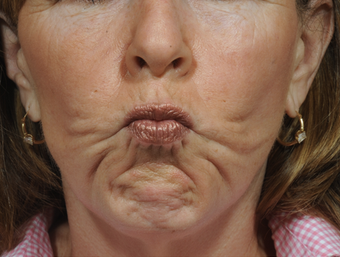 Dermal Fillers before 850330