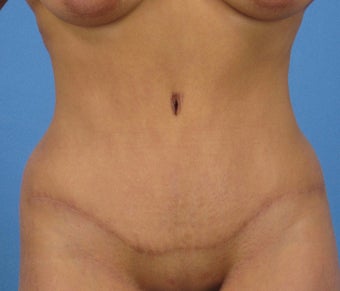 35-44 year old woman treated with Tummy Tuck and circumferential liposuction after 3656706