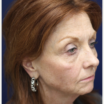 55-64 year old woman treated with Injectable Fillers before 3137247