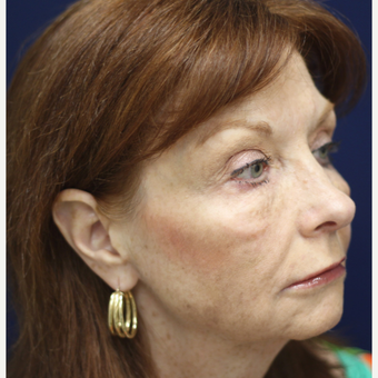 55-64 year old woman treated with Injectable Fillers after 3137247
