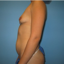 25 year old woman treated with Mommy Makeover before 3293482