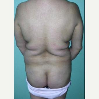 45-54 year old woman treated with Brazilian Butt Lift before 2241644