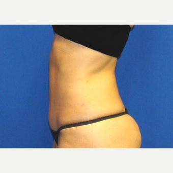53 year old woman treated with Mini Tummy Tuck and Contour Liposuction 1588609
