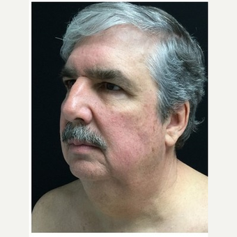 55-64 year old man treated with Facelift before 3219492