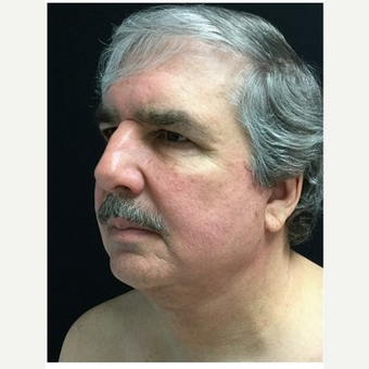 55-64 year old man treated with Facelift after 3219492