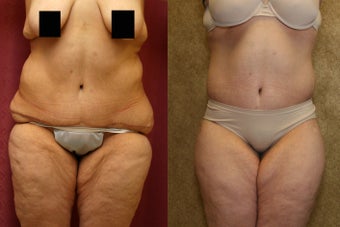 tummy tuck revision to remove dog ears before 993795