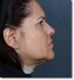 Face & Neck Lift 624911
