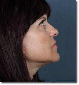 Face & Neck Lift 624911