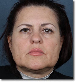 Face & Neck Lift before 624911