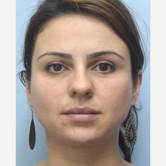 Woman treated with Eye Bags Treatment 1538899