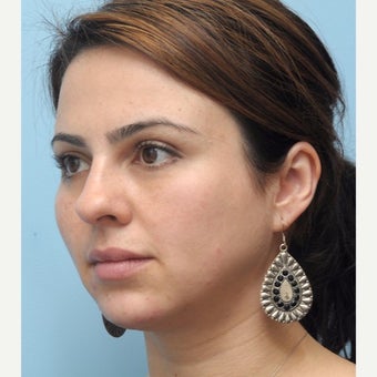 Woman treated with Eye Bags Treatment after 1538899