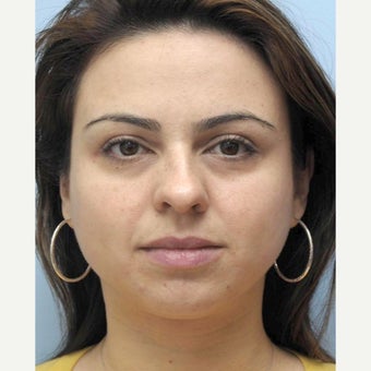 Woman treated with Eye Bags Treatment 1538899