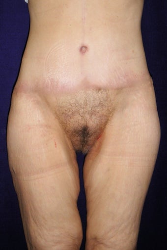 Tummy Tuck/Body Lift after 484457