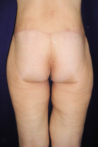 Tummy Tuck/Body Lift 484457