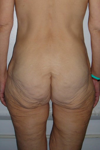 Tummy Tuck/Body Lift 484457