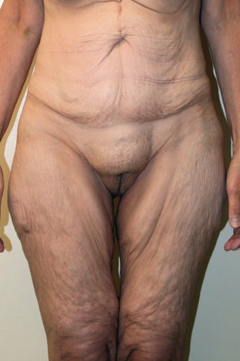 Tummy Tuck/Body Lift before 484457
