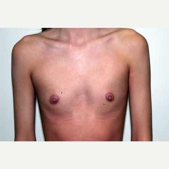 18-24 year old woman treated with Breast Augmentation before 3377578