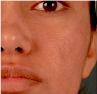 18-24 year old woman treated with Acne Scars Treatment 1961280