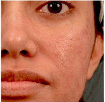 18-24 year old woman treated with Acne Scars Treatment 1961280