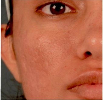 18-24 year old woman treated with Acne Scars Treatment after 1961280