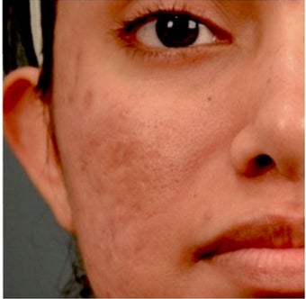 18-24 year old woman treated with Acne Scars Treatment before 1961280