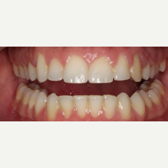 25-34 year old man treated with Braces after 3188479