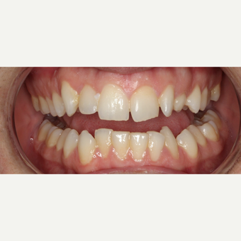 25-34 year old man treated with Braces before 3188479
