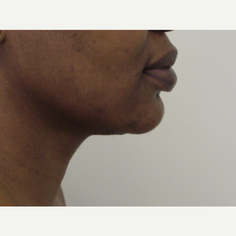 45-54 year old woman treated with Chin Liposuction after 3618575