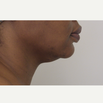 45-54 year old woman treated with Chin Liposuction before 3618575
