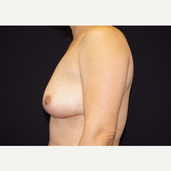 35-44 year old woman treated with Breast Implants before 3441109