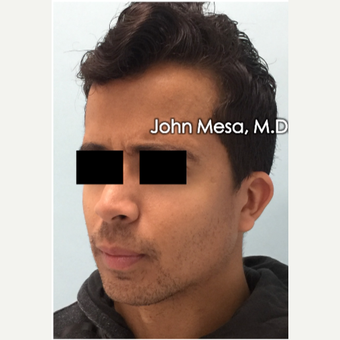18-24 year old treated with Buccal Fat Removal and placement of mandible angle medpore implant after 3266805