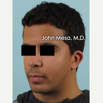 18-24 year old treated with Buccal Fat Removal and placement of mandible angle medpore implant before 3266805