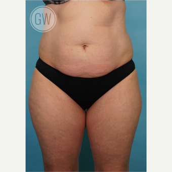 35-44 year old woman treated with Liposculpture before 3016648