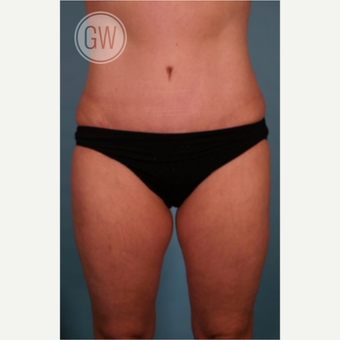 35-44 year old woman treated with Liposculpture after 3016648