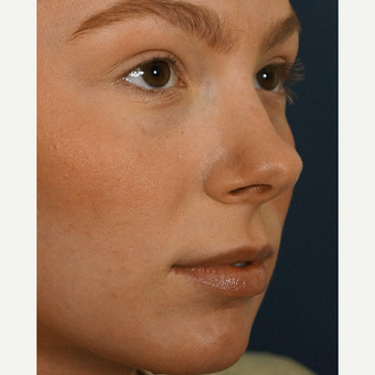 18-24 year old woman treated with Lip Augmentation before 3245007