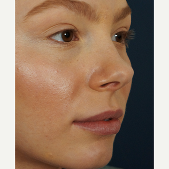 18-24 year old woman treated with Lip Augmentation after 3245007