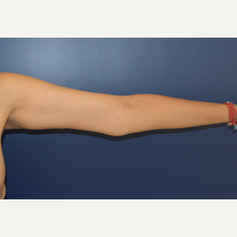 35-44 year old woman treated with Arm Lift after 3408501