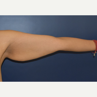 35-44 year old woman treated with Arm Lift before 3408501