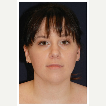25-34 year old woman treated with Chin Liposuction before 3174935