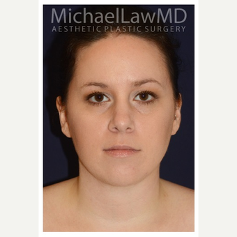 25-34 year old woman treated with Chin Liposuction after 3174935