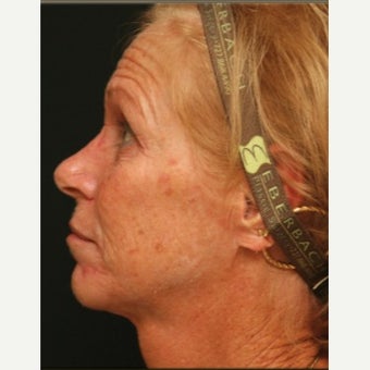 2 Months Post-op Croton Oil Peel Patient 1965183