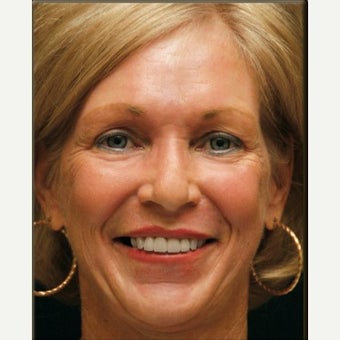 2 Months Post-op Croton Oil Peel Patient after 1965183