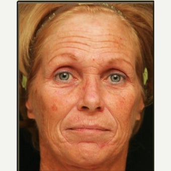 2 Months Post-op Croton Oil Peel Patient before 1965183