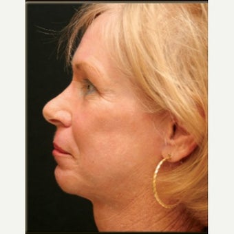 2 Months Post-op Croton Oil Peel Patient 1965183