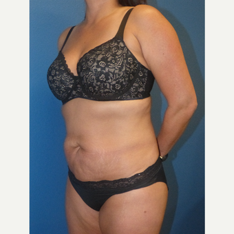 35-44 year old woman treated with Tummy Tuck before 3595831