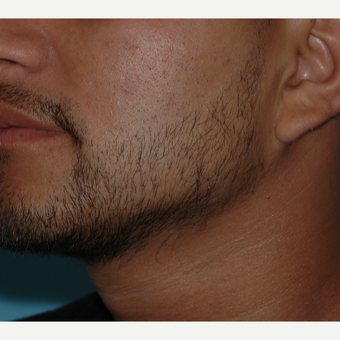 25-34 year old man treated with SmartGraft Hair Transplant to the beard for hypotrichia after 3060024