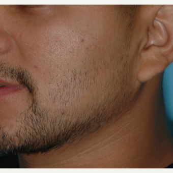 25-34 year old man treated with SmartGraft Hair Transplant to the beard for hypotrichia before 3060024